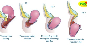 Thật hạnh phúc khi không còn những cơn đau căng tức vùng bụng dưới vì sa tử cung